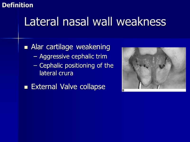 >Lateral nasal wall weakness Alar cartilage weakening Aggressive cephalic trim Cephalic positioning of the